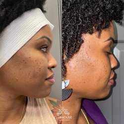 ClubHouse Skin and Laser Medspa - EVEN GLOW PEEL SERIES