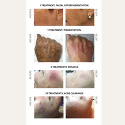 Rejuvené MedSpa & Wellness Center - Treat hyperpigmentation, rosacea, acne and acne scarring, with laser treatments at Rejuvené Med Spa