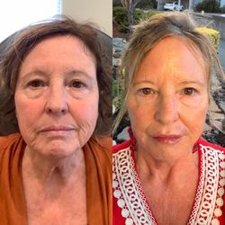 Rejuvenate Medi-Spa & Wellness - Before and after facial and lip filler