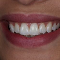 Bayview Dentistry - Smile after whitenning.