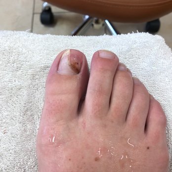 Pearl Nails - Sept 2018 - the brown you see is dirt the part that was cut was the entire area where my toenail had lifted - Nail Technicians Near Me - Campbell, California Pearl Nails - Sept 2018 - the brown you see is dirt the part that was cut was the entire area where my toenail had lifted - Nail Technicians Near Me - Campbell, California