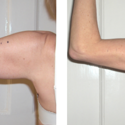 Strawberry Laser Lipo of Kissimmee