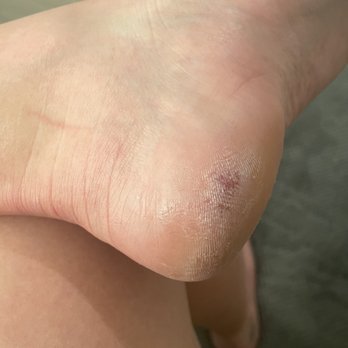 Element Nail Bar - 4 days later still is not healed and difficult to walk on - Nail Salons Near Me - Phoenix, Arizona Element Nail Bar - 4 days later still is not healed and difficult to walk on - Nail Salons Near Me - Phoenix, Arizona