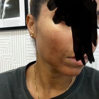 NAKEDMD - Phoenix - Day 3.. scapes all over my face - Medical Spas Near Me - Phoenix, Arizona