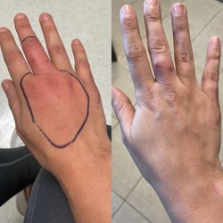 MedPost Urgent Care of Rowlett - Day 1 cat bite, marked at clinic vs Day 3 on antibiotics.