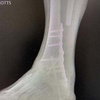 My Aim - Side view exray - Podiatrists Near Me - Gilbert, Arizona