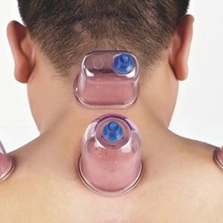Faith TCM Acupuncture & Cupping - Cupping reduces pain, muscle tightness and inflammation, improves blood flow (circulation) and increases range of motion.