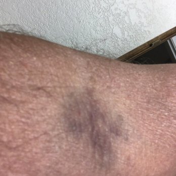 Quest Diagnostics - Bruised from needle - Laboratory Testing Near Me - Roseville, California
