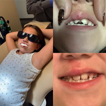 Crossing Dental Group and Orthodontics - They restored her teeth within hours. They made sure she was comfortable, walked us through the treatment and were reasonably priced. - General Dentistry Near Me - Perris, California Crossing Dental Group and Orthodontics - They restored her teeth within hours. They made sure she was comfortable, walked us through the treatment and were reasonably priced. - General Dentistry Near Me - Perris, California