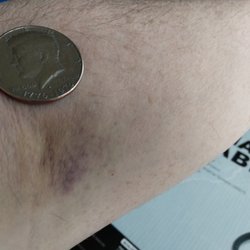 Mid-Willamette Family Medicine - Bruise from a blood draw