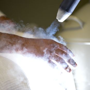 CryoCure - A Cool Photo We got, capturing the Localized Cryotherapy Treatment applied to the hand/knuckle - Acupuncture Near Me - Hewlett, New York