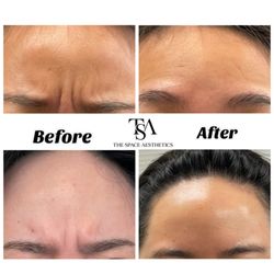 The Space Aesthetics - Botox injection for "11" line