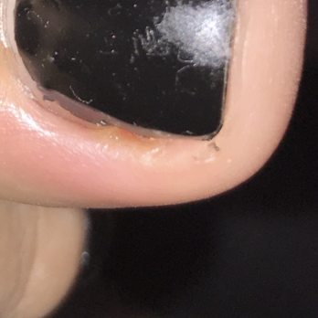 Botanical Nails & Spa - Close up of infection inside - Nail Salons Near Me - Patterson, California