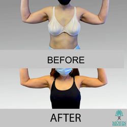 Liposuction Center Moein Surgical Arts - Renuvion or also known as J plasma. Non-surgical skin tightening