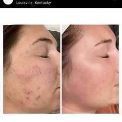 Glow Rx - Microneedling