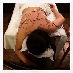 East West Wellness Center - Acupuncture + electrical on a patient with neck and shoulder pain. After 10 sessions, her chronic pain was 80% better.