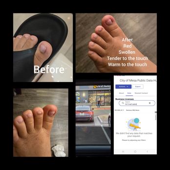 Hi5 Nails & Spa - My daughter's toe in the salon on that day. And her toe days after red, hot to the touch and swollen - Nail Salons Near Me - Mesa, Arizona Hi5 Nails & Spa - My daughter's toe in the salon on that day. And her toe days after red, hot to the touch and swollen - Nail Salons Near Me - Mesa, Arizona