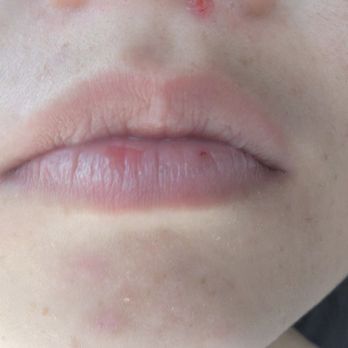 KidShine Orthodontics - When i "rest" my mouth uncomfortably, inside mouth is slightly open on one side - Orthodontists Near Me - Pearl City, Hawaii KidShine Orthodontics - When i "rest" my mouth uncomfortably, inside mouth is slightly open on one side - Orthodontists Near Me - Pearl City, Hawaii