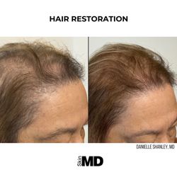 SkinMD Peabody - Skin MD's proprietary hair restoration