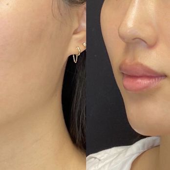 Ageless MD - Nose and chin filler - Medical Spas Near Me - Tustin, California