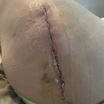 Rasmussen J Linda, MD - One week post surgery - Orthopedists Near Me - Kailua, Hawaii Rasmussen J Linda, MD - One week post surgery - Orthopedists Near Me - Kailua, Hawaii