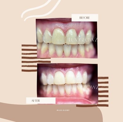 Teeth Whitening! - See the difference with the teeth whitening! Teeth Whitening! - See the difference with the teeth whitening!