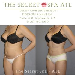 BEFORE & AFTER
Our clients wanted to lose weight without the pain, hassle of taking off work, or simply just a lot of down time.