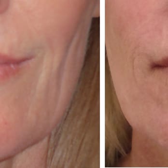 Kimberly Cockerham, MD - Before and after platelet rich plasma to diminish lines and help build collagen - Cosmetic Surgeons Near Me - Stockton, California