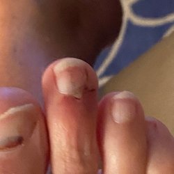 Southern Urgent Care - Same toe two days later after removing bandage.