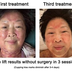 Red Cupping Clinic - This patient was only in Seattle for 5 days and so she had 3 facial lift therapies in that short period with great results!