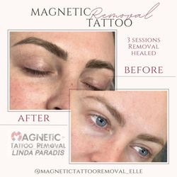 3 sessions of Magnetic Tattoo Removal, no scarring, no hair loss