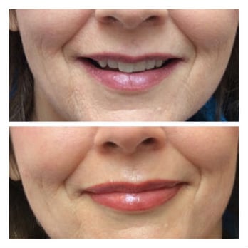 Prettyology - Lips before & immediately after semi permanent makeup by Prettyology. Pigments soften after a few days. - Permanent Makeup Near Me - Peabody, Massachusetts