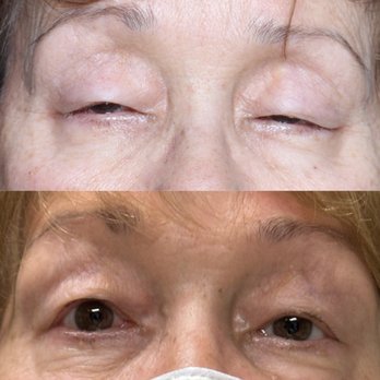 Justin Karlin, MD - Ptosis Surgery - Ophthalmologists Near Me - Beverly Hills, California Justin Karlin, MD - Ptosis Surgery - Ophthalmologists Near Me - Beverly Hills, California