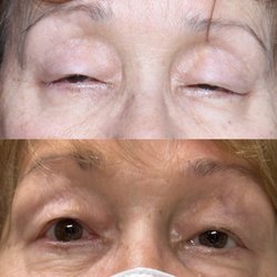 Justin Karlin, MD - Ptosis Surgery