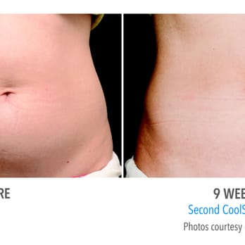 Radiance Medspa - Now....offering Coolsculpting Fear no Mirror - Day Spas Near Me - West Chester, Pennsylvania Radiance Medspa - Now....offering Coolsculpting Fear no Mirror - Day Spas Near Me - West Chester, Pennsylvania