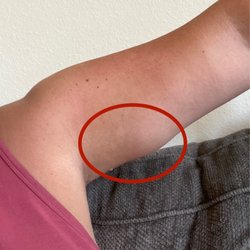 Modern Family Medicine - My lump that many said was a lipoma