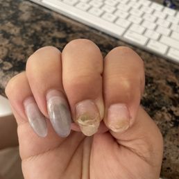 Fungus growing under my nail.