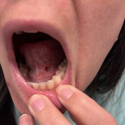 Village Family Dental - Hope Mills - The day after my tongue was extremely sore