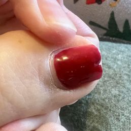 Began as a dent, then split. Never ever had this happen before, only happened on one toe.