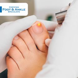 Certified Foot & Ankle Specialists - Laser therapy for toenail