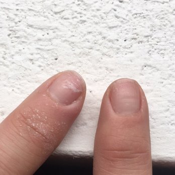 Bella Nails & Spa - This is both my index fingers. The left one is infected so I took off the gel polish to clean it out. Maybe the tools weren't clean? - Nail Salons Near Me - Brea, California