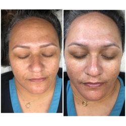 Savvy Skin Spa - Beauty Bomb before and after.  Troubled skin treatments Solana Beach CA | Skin Care Facial in Solana Beach California