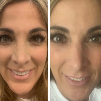 Advanced SkinCare - Left us before Right is an hour after tear trough filler - Medical Spas Near Me - Fullerton, California