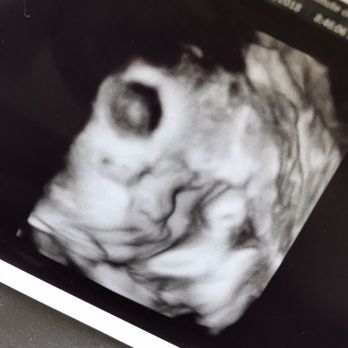 Ardeshir Karimi, MD - Good quality ultrasound of my little one  (the black spot is just from the angle they took it lol) - Doctors Near Me - San Gabriel, California