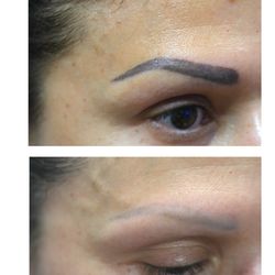 Before and After picture of Microbladeling /Tattoo Removal using our PicoSure laser!