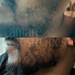 Amare Aesthetics - Hair growth