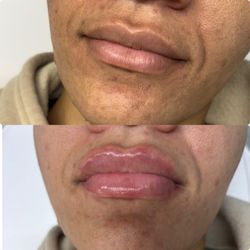 Lip filler using Juvederm Ultra XC