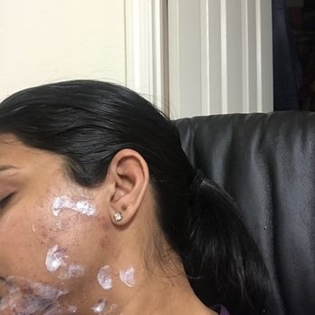 LaserAway - Laser Hair Removal Near Me - Fremont, California
