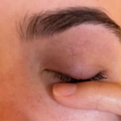 Deka Lash - Swollen eyelid