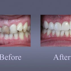 Veneers